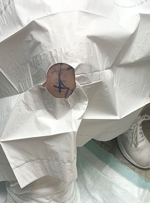 regenerative medicine